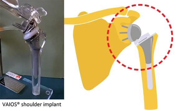 VAIOS® shoulder implant